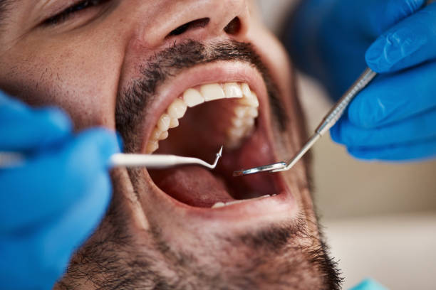 Best Wisdom Tooth Removal  in Sausalito, CA