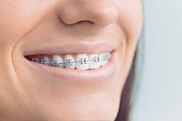 Dental Bonding in Sausalito, CA